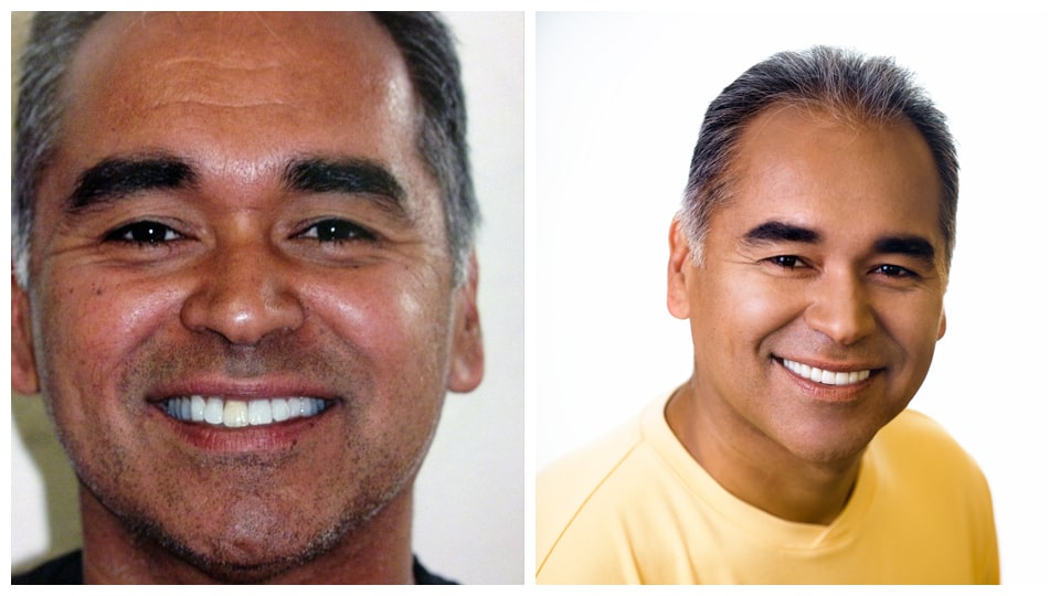 A photo collage featuring two images of a smiling man, captured before and after a smile transformation at Bawa Dentistry