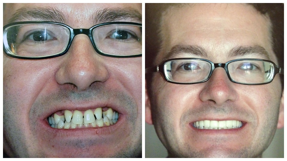 A photo collage featuring two images of a smiling man, captured before and after a transformative smile design at Bawa Dentistry