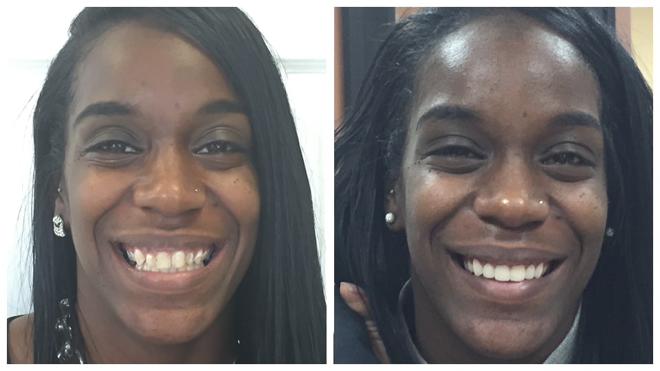 A photo collage featuring two images of a smiling woman, captured before and after smile design procedures at Bawa Dentistry