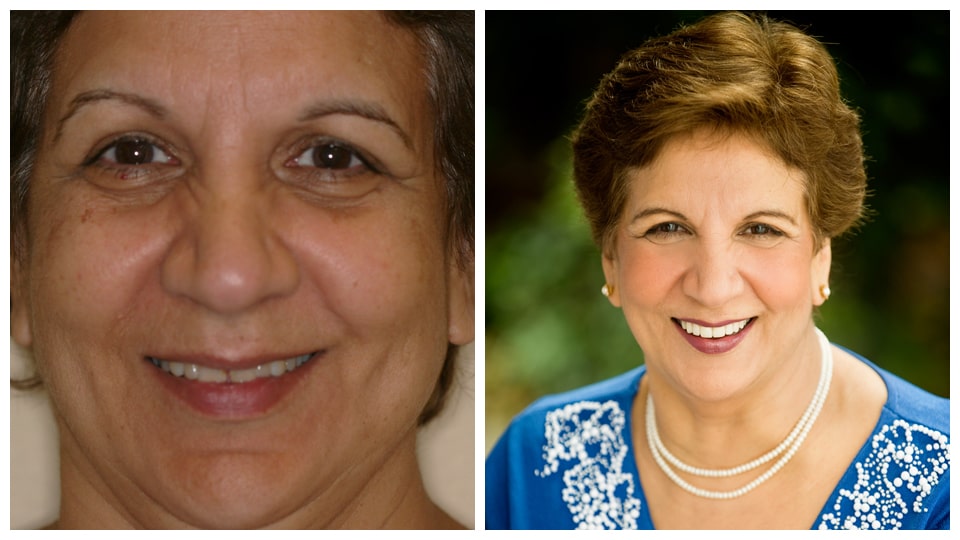 A photo collage featuring two images of a smiling woman, captured before and after smile transformation at Bawa Dentistry